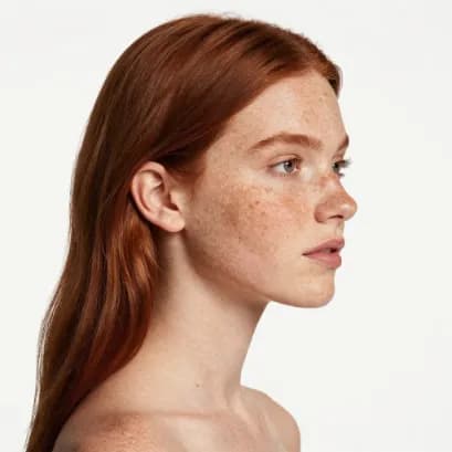 Freckles